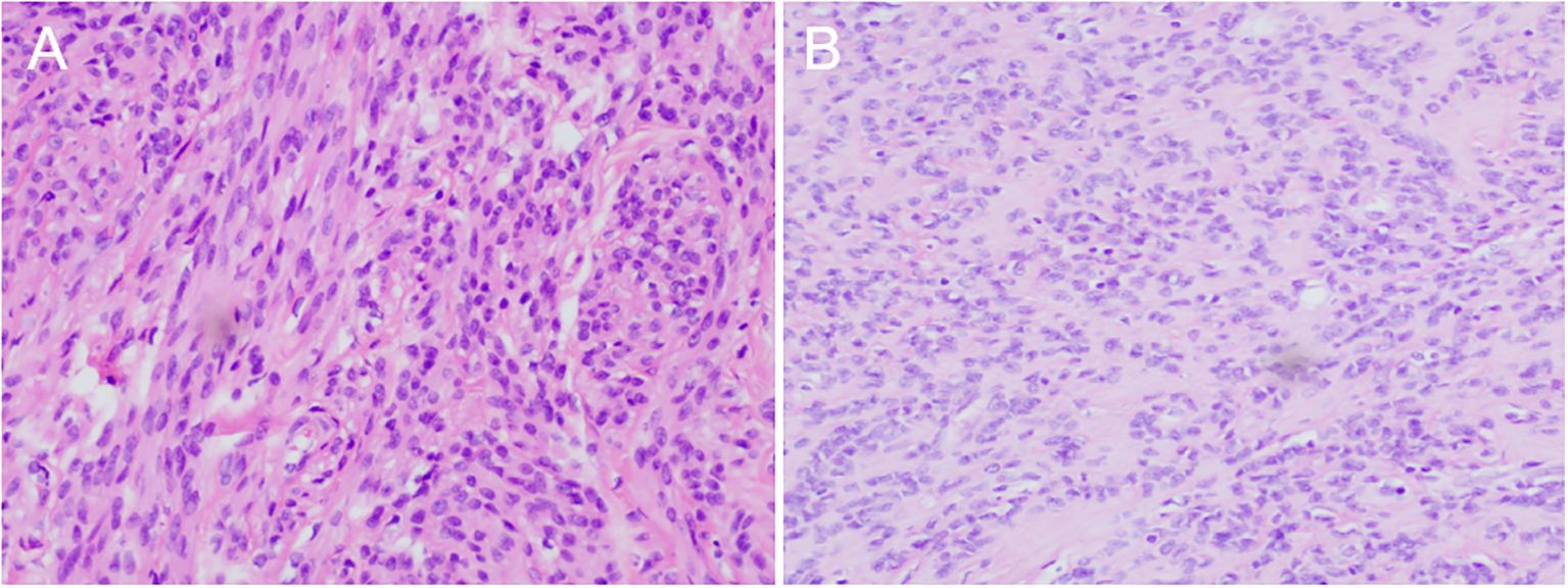 Histological images showing two panels labeled A and B, comparing tissue samples. Panel A displays dense, pink-stained tissue with numerous dark purple nuclei. Panel B shows a similar pattern but with lighter staining and fewer nuclei, indicating a difference in cell density or composition.