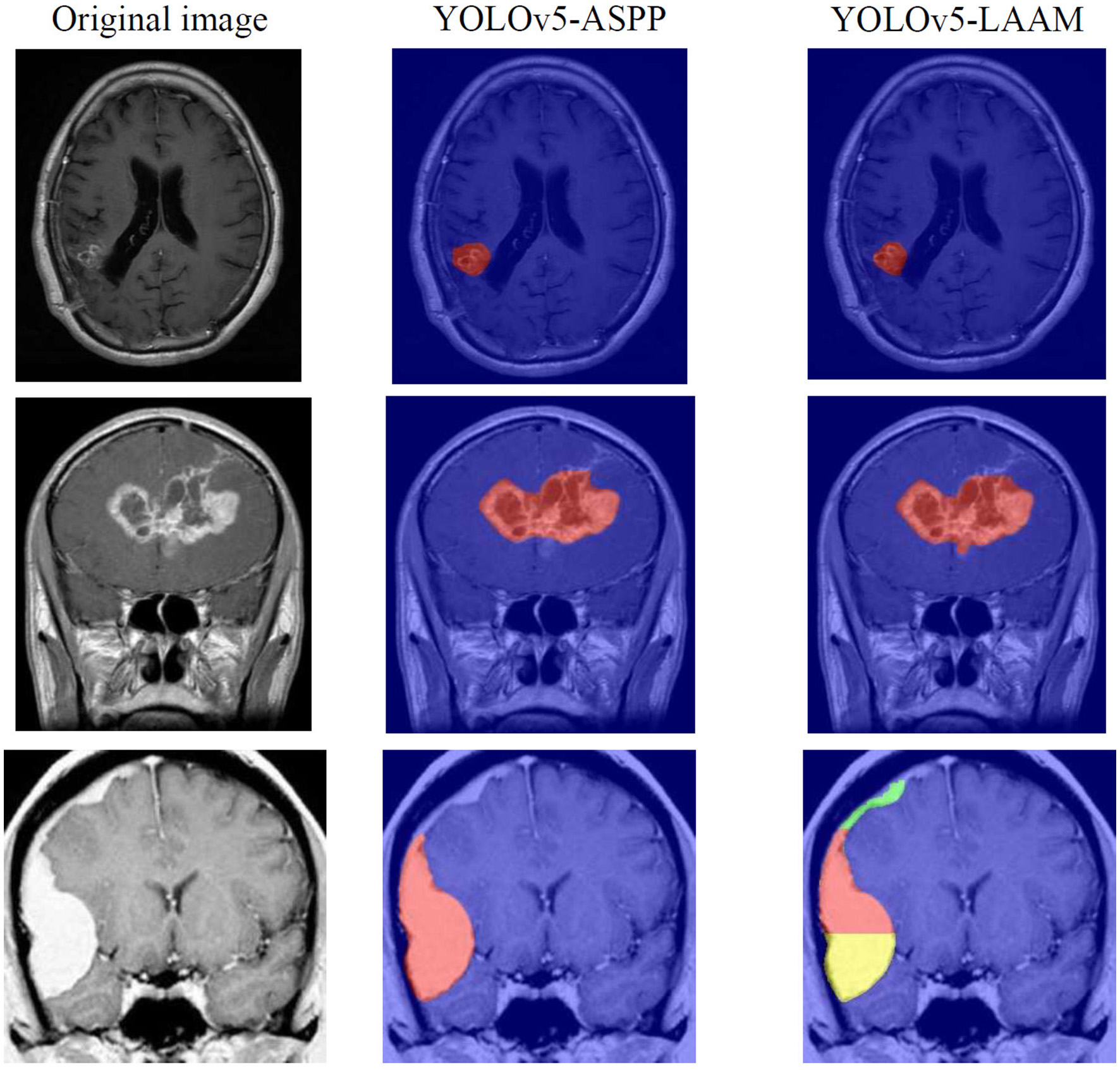 Six medical brain scans are displayed in three columns. The first column shows original MRI images, while the second and third columns show results processed by YOLOv5-ASPP and YOLOv5-LAAM models. Red-highlighted areas indicate detected anomalies on the processed images. The third column's bottom image includes additional green and yellow highlights.