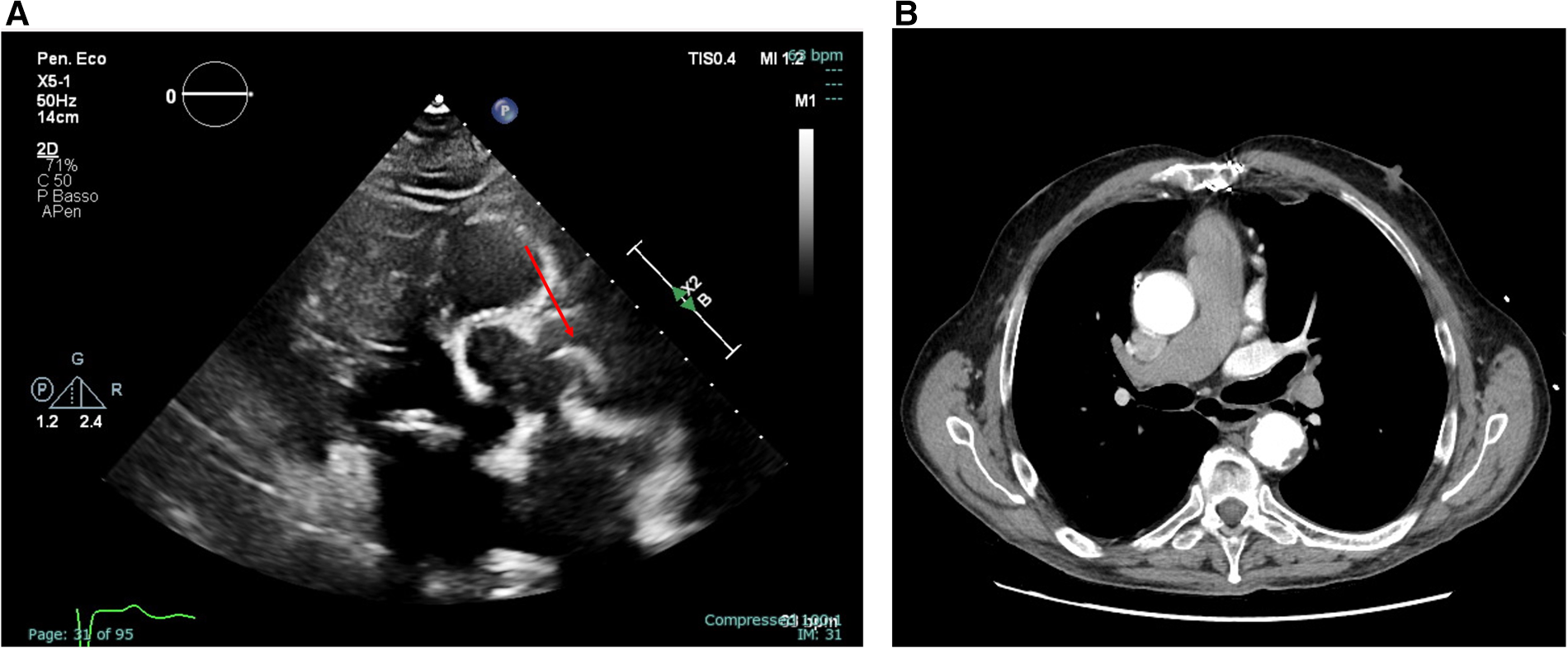An ultrasound (left) and a CT scan (right) of a thoracic region. The ultrasound shows grayscale imaging with a red arrow pointing to a specific area, indicating potential observation of interest. The CT scan displays a cross-sectional view of the chest, highlighting different structures like bones and blood vessels in contrasting shades.