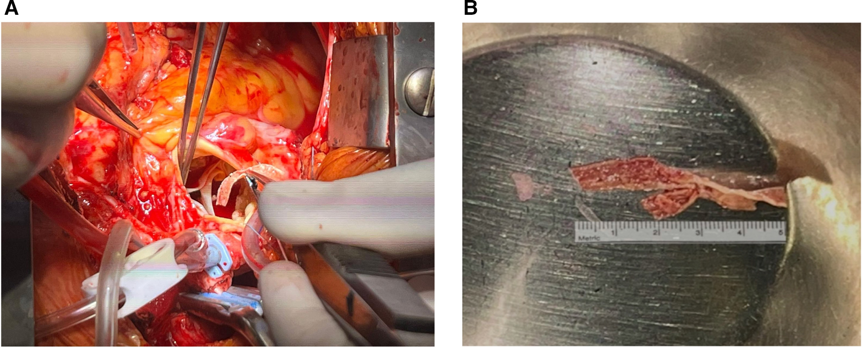 Left image shows a surgical procedure with exposed tissue and medical instruments. Right image displays a removed tissue sample next to a ruler on a metal surface.