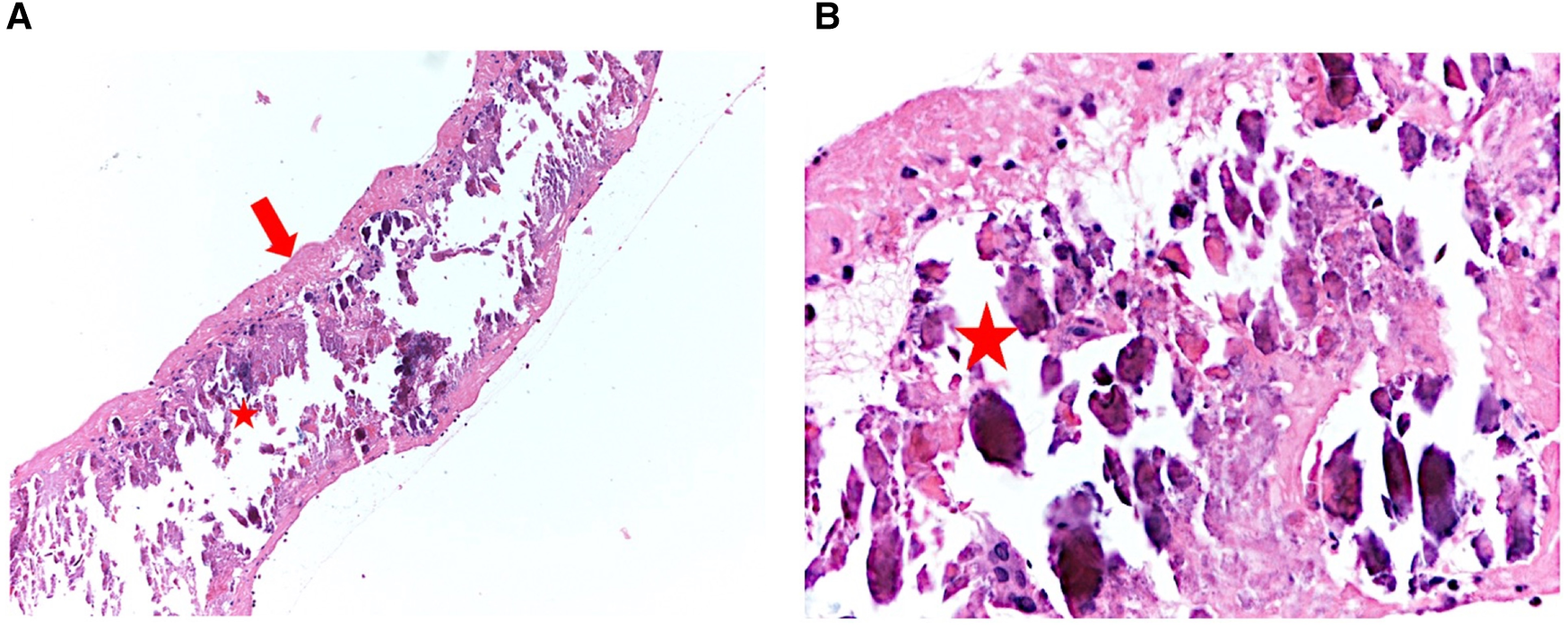 Histological slides show bone marrow tissue with pink-stained areas and dark cell nuclei. Red arrows and a star highlight specific features. The left image shows a zoomed-out view, while the right provides a detailed close-up.