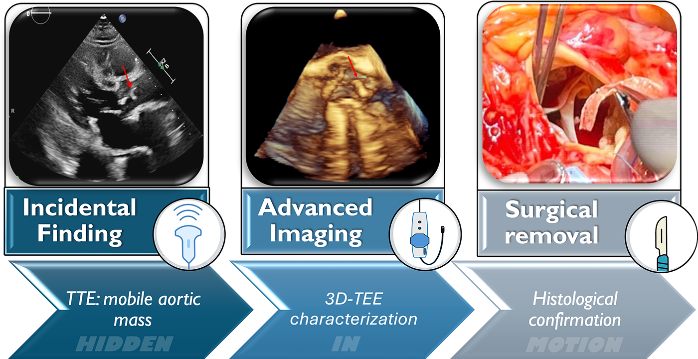 Three-panel clinical workflow graphic showing the progression from incidental finding to surgical removal of an aortic mass. The first panel shows a transthoracic echocardiogram (TTE) with a red arrow pointing to a mobile aortic mass, labeled "Incidental Finding." The second panel displays a 3D transesophageal echocardiogram (TEE) image for further characterization, labeled "Advanced Imaging." The third panel presents an intraoperative photo of open-heart surgery with instruments manipulating tissue, labeled "Surgical removal." Arrows below indicate the diagnostic steps: "HIDDEN" with TTE, "IN" with 3D-TEE, and "MOTION" with histological confirmation.