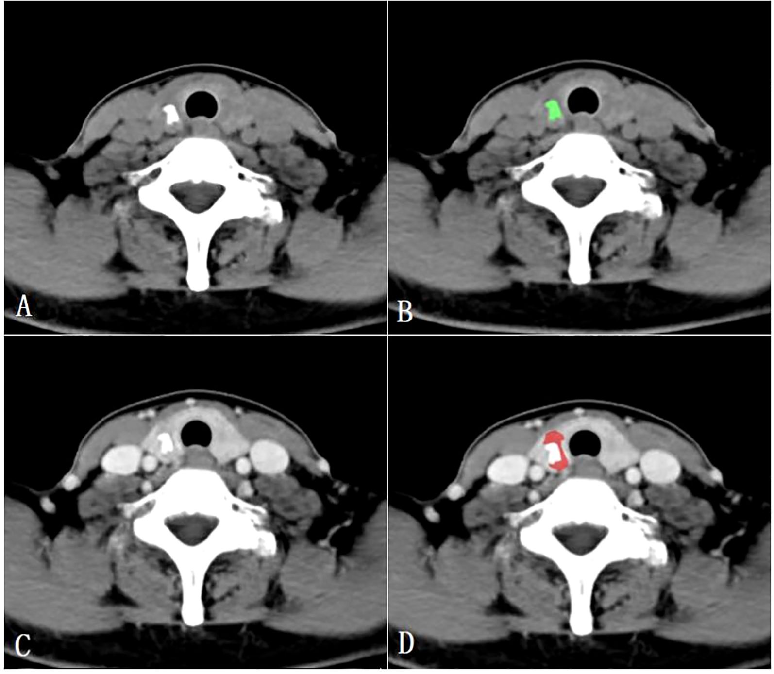 CT scan images in four panels labeled A, B, C, and D. Panels B and D highlight areas of interest with color markings. Each image features a cross-sectional view of the neck, showing the spine and surrounding tissues. Panel B has a green marking, and Panel D has a red marking, indicating specific points of focus for medical analysis.