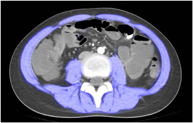 CT scan cross-sectional image of the abdomen, displaying internal organs and structures. The intestines and surrounding tissues are visible, with varying shades representing different densities.