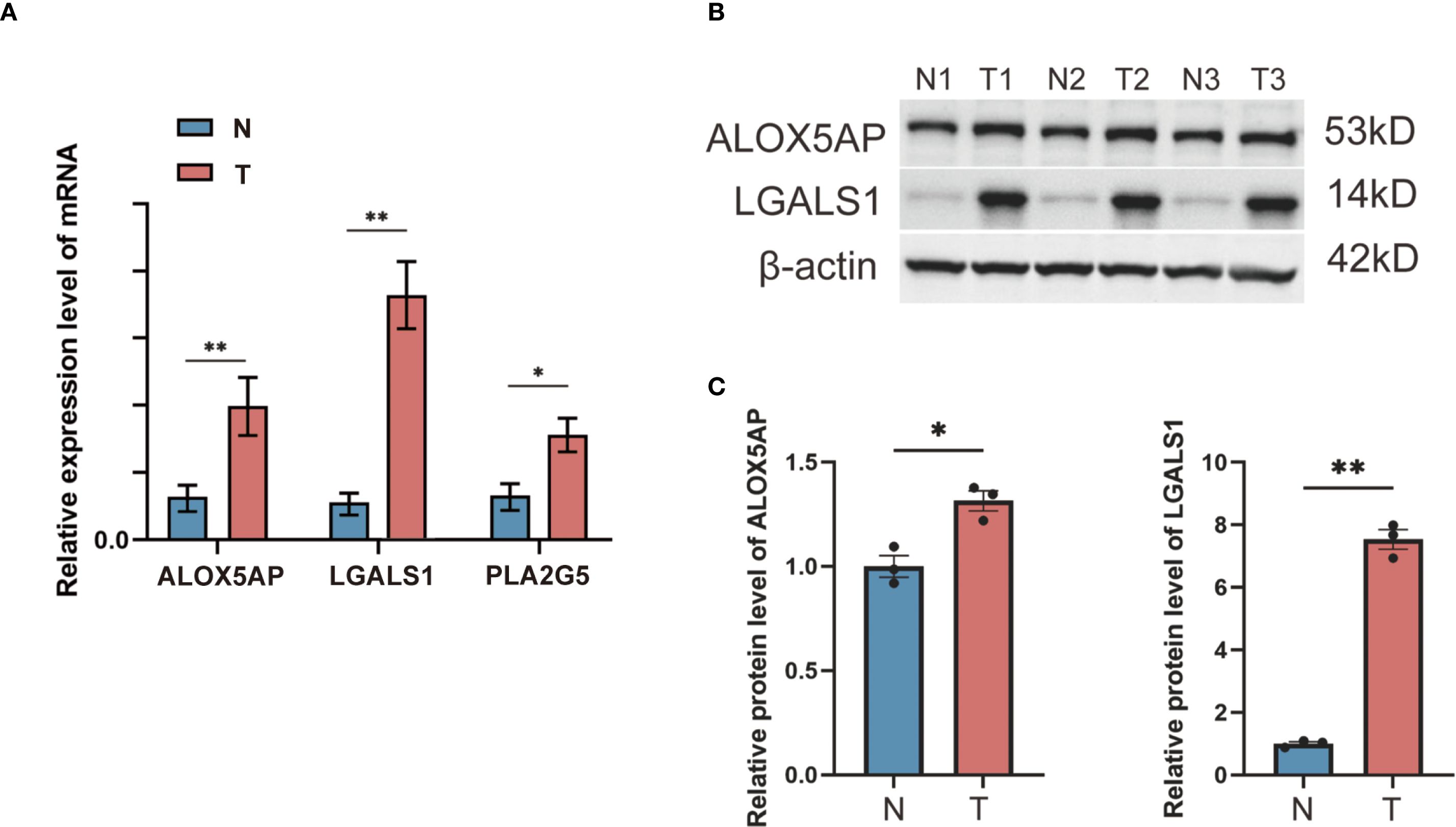 Bar graph, gel electrophoresis, and bar graph in three panels labeled A, B, and C. Panel A shows mRNA expression levels of ALOX5AP, LGALS1, and PLA2G5, with red (T) being higher than blue (N). Panel B is a gel showing protein bands for ALOX5AP, LGALS1, and β-actin across six lanes. Panel C features bar graphs for protein levels of ALOX5AP and LGALS1, with red (T) higher than blue (N). Asterisks indicate significance levels.