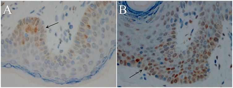 Microscopic images labeled A and B show cell structures with arrows indicating specific points. Both images display cells with varying brown and blue staining, highlighting different tissue characteristics. Image A shows a concentrated brown area, while image B displays dispersed brown cells, suggesting different staining patterns or levels of expression.