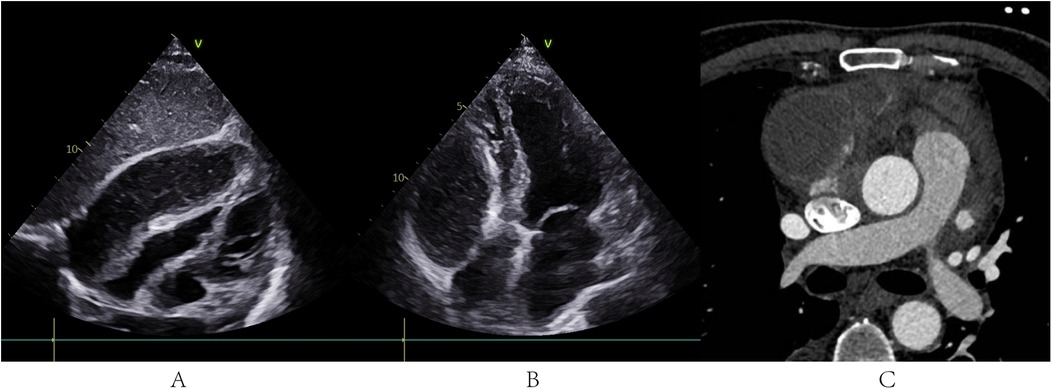 Panel A shows an echocardiographic image of the heart in the parasternal long-axis view. Panel B displays another echocardiographic image of the heart in the apical four-chamber view. Panel C is a CT scan showing the thoracic aorta in a cross-sectional view, including surrounding structures.