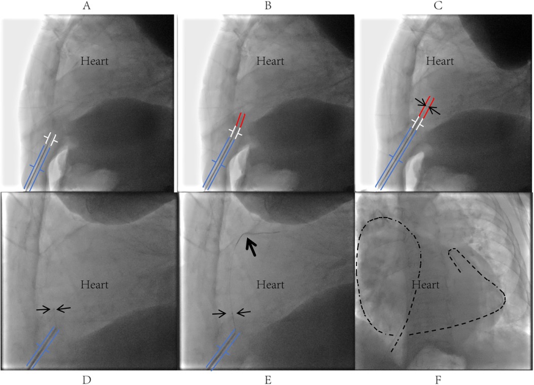 Six-panel angiography showing a heart and catheters near the organ. Panels A, B, and C highlight catheter positioning with blue, white, and red lines. Arrows in Panels D and E indicate catheter directions, while dashed lines in Panel F outline heart contours.
