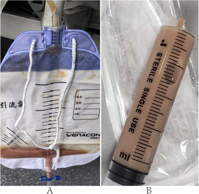 Collection bag with brown liquid on the left, marked with measurement lines and text in a foreign language. On the right, a syringe labeled \
