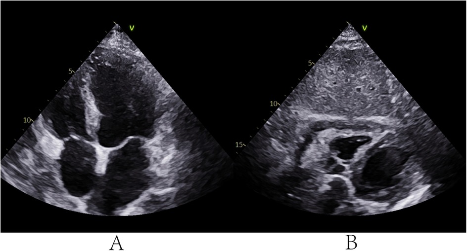 Ultrasound images labeled A and B. Image A shows a section with a distinct structure and varying shades of gray, suggestive of different tissue densities. Image B displays another section with additional dark areas, indicating variations in density or fluid presence. Both are part of a medical imaging procedure.