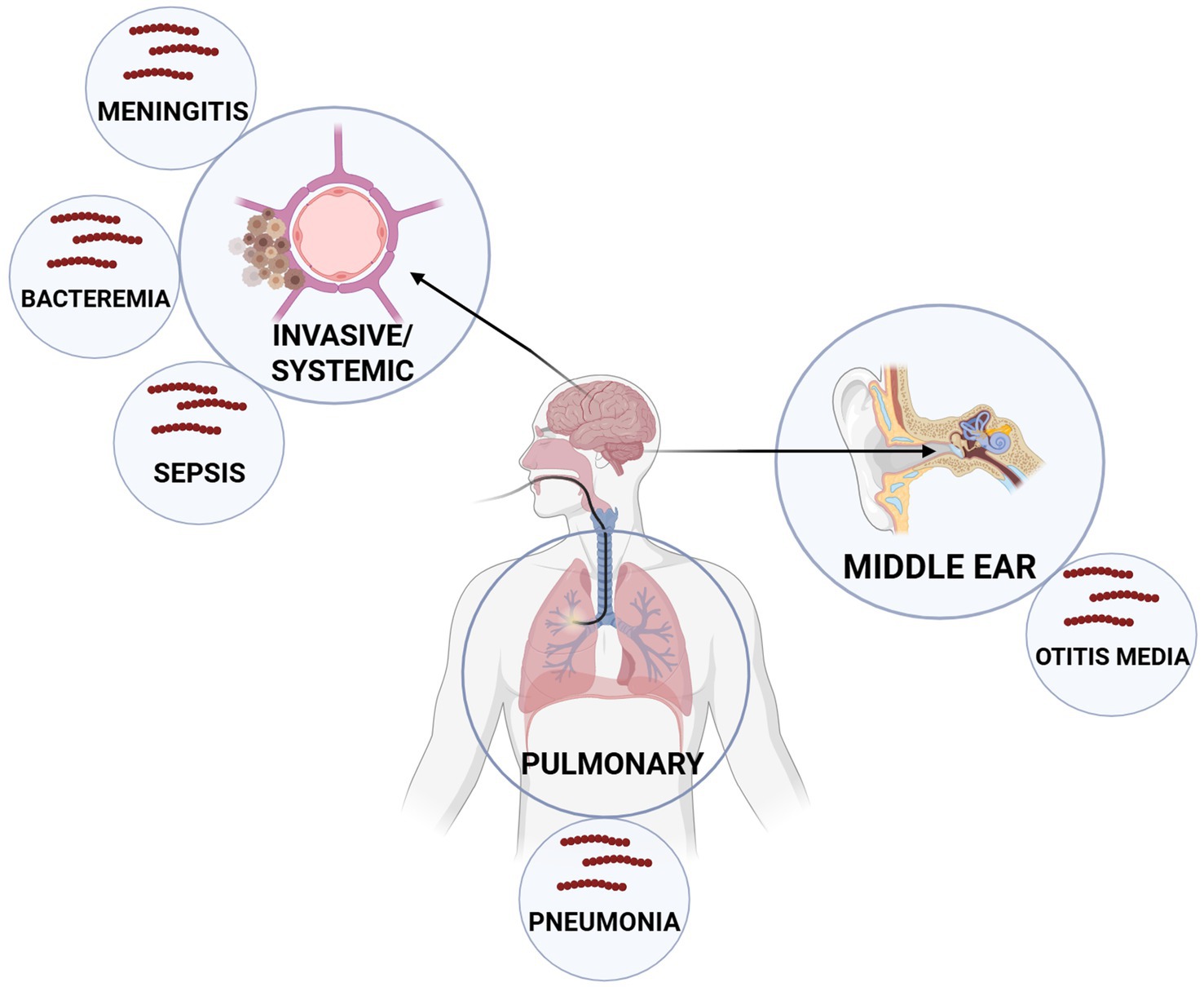 Diagram showing human respiratory and ear systems affected by infections. Invasive/systemic infections like meningitis, bacteremia, and sepsis are highlighted with a pathogen icon. The middle ear is linked to otitis media, and the lungs to pneumonia.
