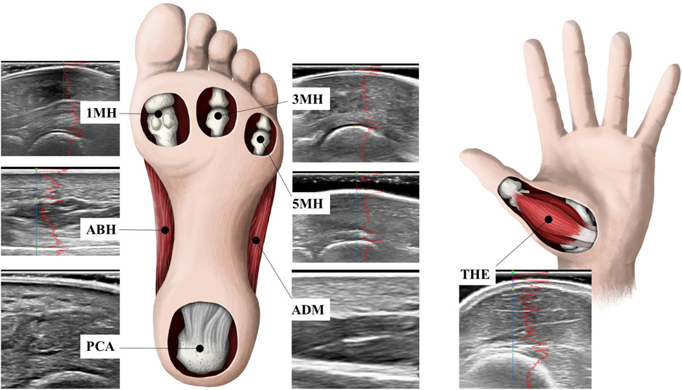 Illustration of a foot and hand showing cross-sections of muscles and bones at the sites where pressure-pan and tissue thickness measurements were made. The foot is labeled with 1MH, ABH, PCA, 3MH, and 5MH, while the hand is labeled with THE. Adjacent ultrasound images show detailed tissue structures at each measurement site.