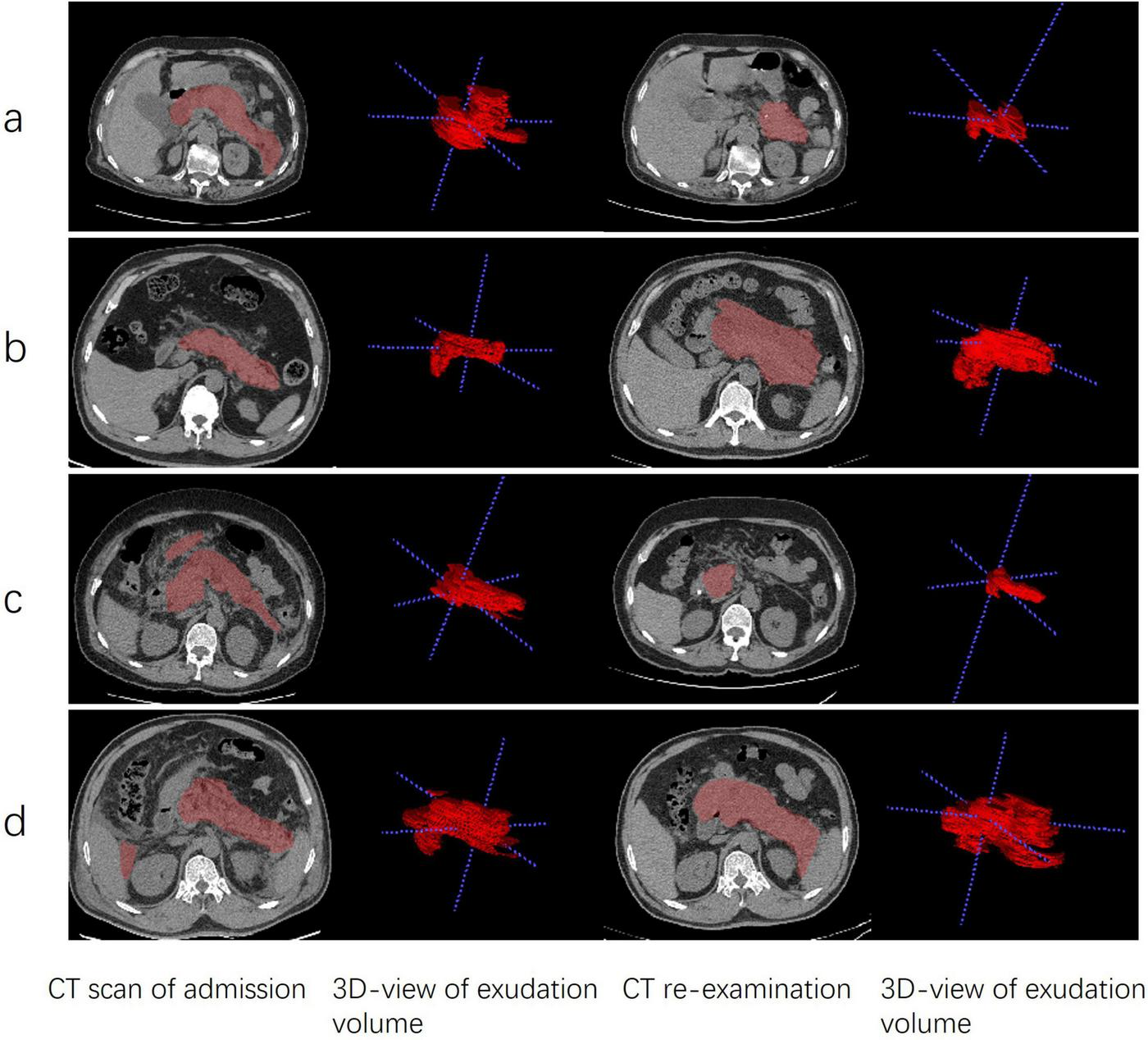 Flowchart showing patient classification and exclusions in a study of 1,950 acute pancreatitis (AP) cases. Exclusions include patients with MAP, transfers, peritoneal drainages, pancreatic necrosis, lack of CT re-examination, short EN duration, and poor image quality. Two main branches: MSAP with 198 cases, subdivided into APFC (150 cases) and ANC (48 cases), and SAP with 130 cases, subdivided into APFC (80 cases) and ANC (50 cases). Each subgroup is divided into EN and non-EN groups.