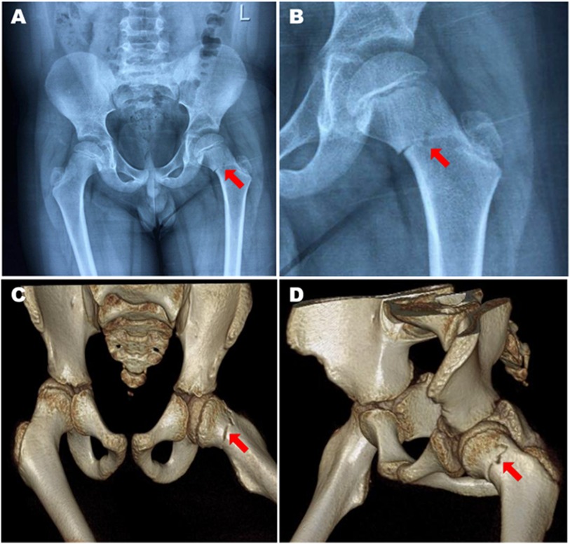 Panel A shows an X-ray of the pelvis with a red arrow highlighting a fracture in the left femur. Panel B presents a close-up X-ray of the left hip, also indicating the fracture. Panels C and D display 3D CT scans of the pelvis and left hip, with red arrows pointing to the same fracture site.