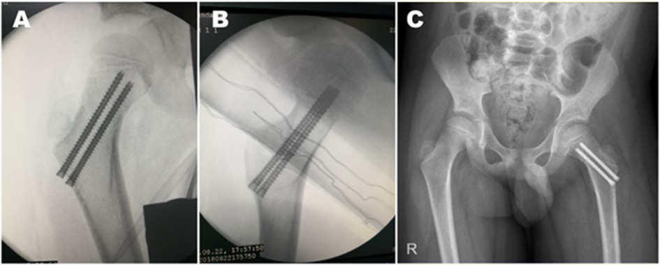X-ray images showing a surgical procedure with hardware in the hip region. Panel A and B display lateral views with rods in place, while panel C shows an anterior-posterior view with visible implants in the right hip area.