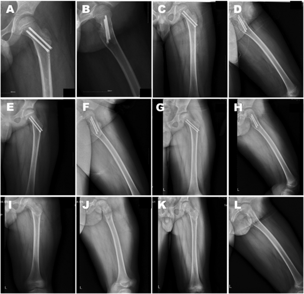 Twelve panel X-ray images labeled A to L showing a series of femur fractures with inserted metal rods. Images depict various angles and stages of healing in the femur bone post-surgery.