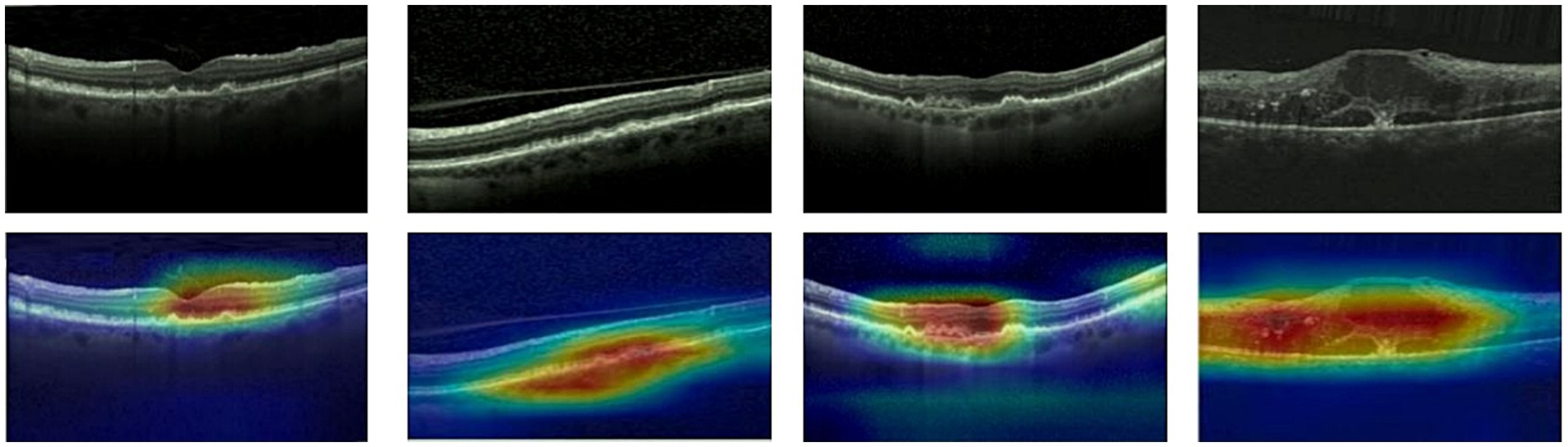 A set of eight OCT (Optical Coherence Tomography) scans of the retina arranged in two rows. The top row consists of grayscale images showing varying retinal textures and thickness. The bottom row displays the same scans in false color, highlighting varying densities with colors transitioning from blue to red, indicating different levels of retinal density and fluid presence.