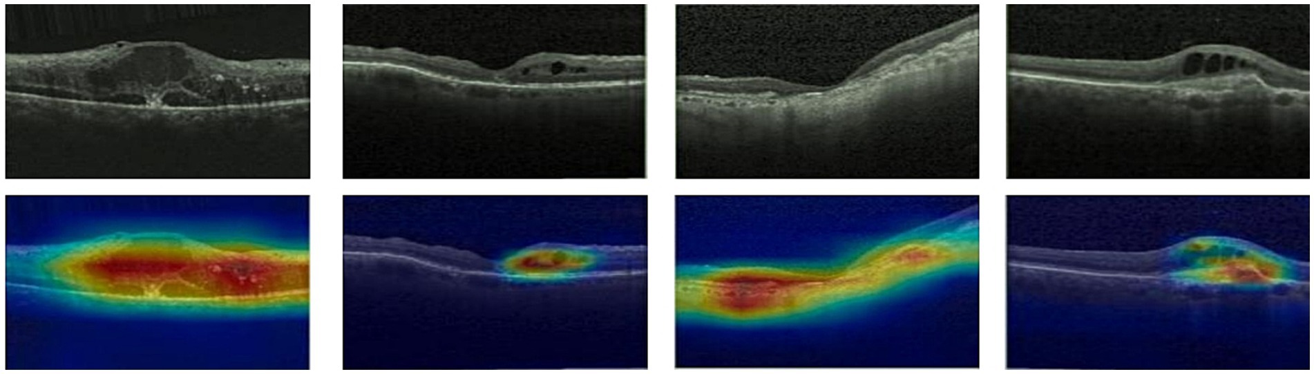 Four pairs of retinal scans are displayed. The top row shows grayscale optical coherence tomography (OCT) images, highlighting structural details of the retina. The bottom row presents color-coded versions of the same scans, where warmer colors, such as red and yellow, likely indicate areas of higher reflectivity or density, while cooler colors like blue and green suggest lower reflectivity or density.