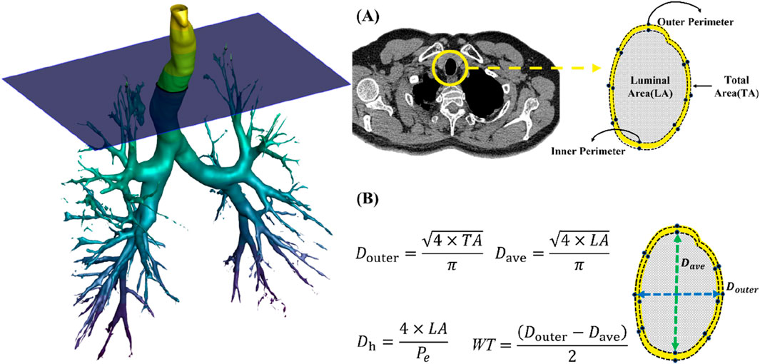 A graphic showing a 3D model of bronchial tubes with a cross-section highlighted. To the right, image (A) displays a CT scan with inner and outer perimeter annotations indicating luminal and total areas. Image (B) shows equations for various diameters and wall thickness, alongside a diagram with dimensions annotated.