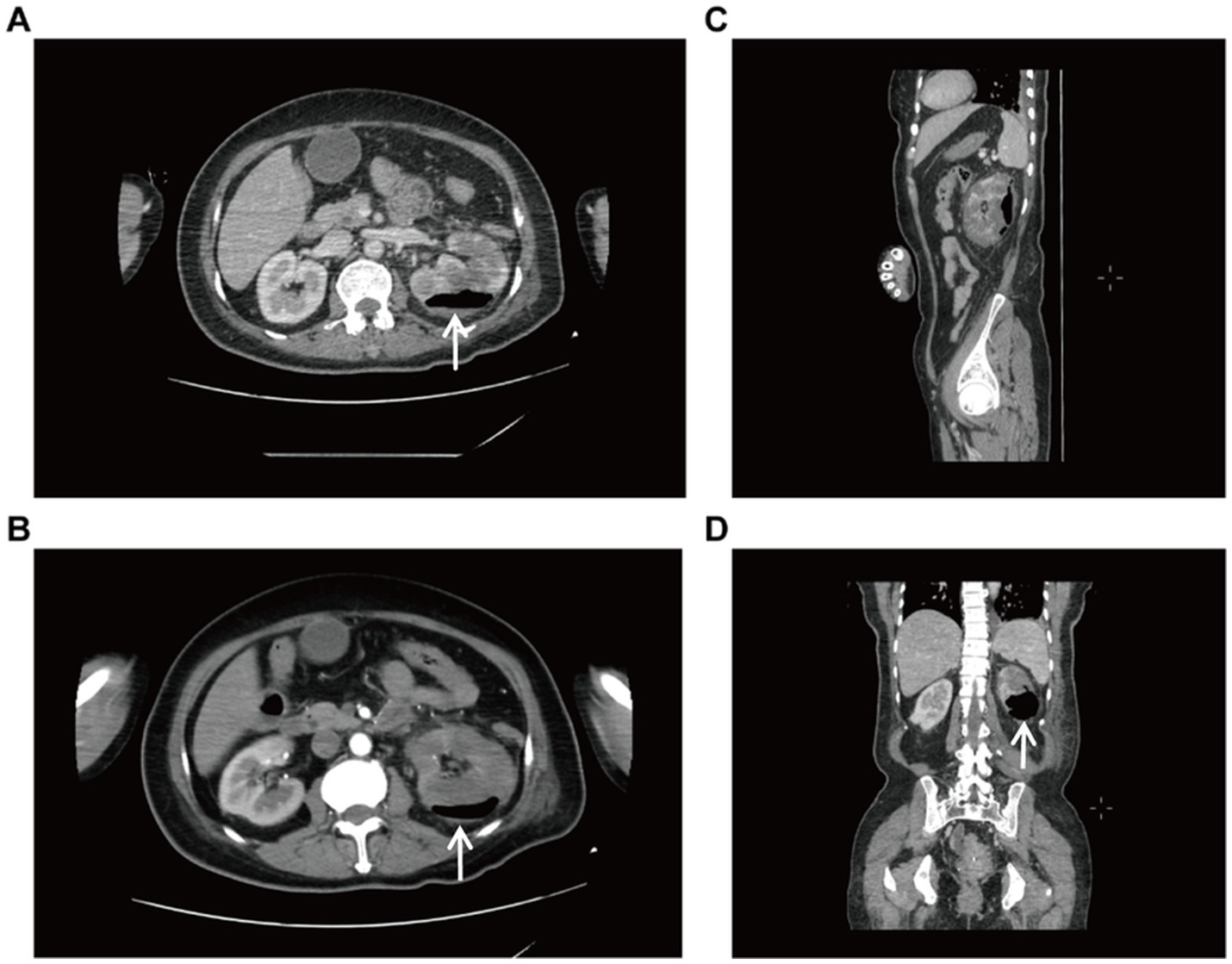 CT scan images labeled A to D show different views of the abdomen. Images A and B are axial views with arrows indicating areas of interest near a kidney. Image C is a sagittal view of the abdomen, and image D is a coronal view, both also highlighting regions with arrows.