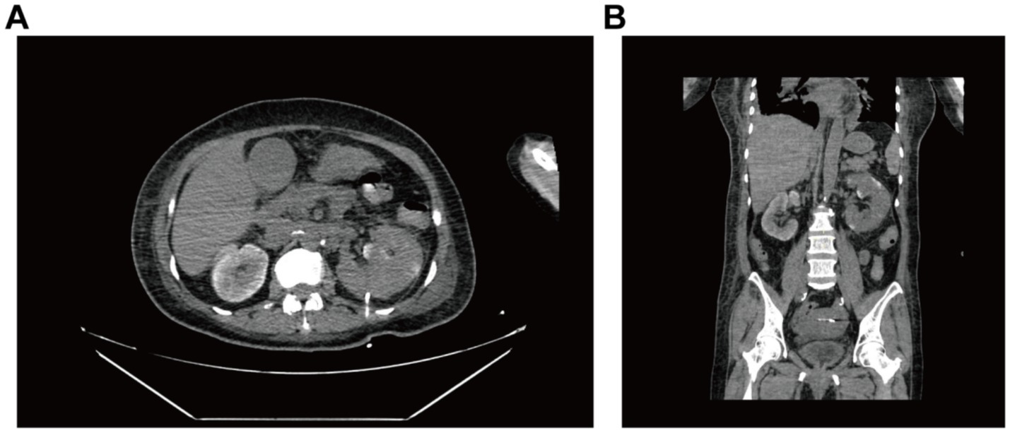 CT scan images showing abdominal cross-sections. Image A displays an axial view, highlighting internal organs such as the kidneys and liver. Image B presents a coronal view, illustrating the vertical alignment of abdominal structures, including the spine and surrounding organs.