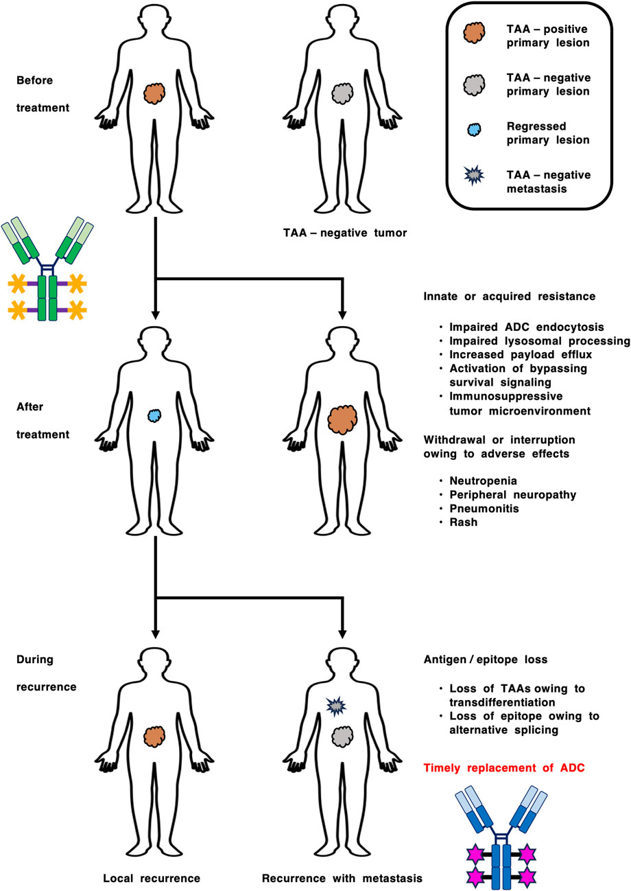 Diagram illustrating tumor progression and resistance to treatment. Before treatment, two figures show TAA-positive and TAA-negative tumors. After antibody-drug conjugate (ADC) treatment, innate or acquired resistance may occur, causing impaired processes and adverse effects like neuropenia and rash. During recurrence, local recurrence or metastasis can happen due to antigen loss. A timely replacement of ADC is suggested. A legend identifies tumor states: TAA-positive lesion, TAA-negative lesion, regressed lesion, and TAA-negative metastasis.