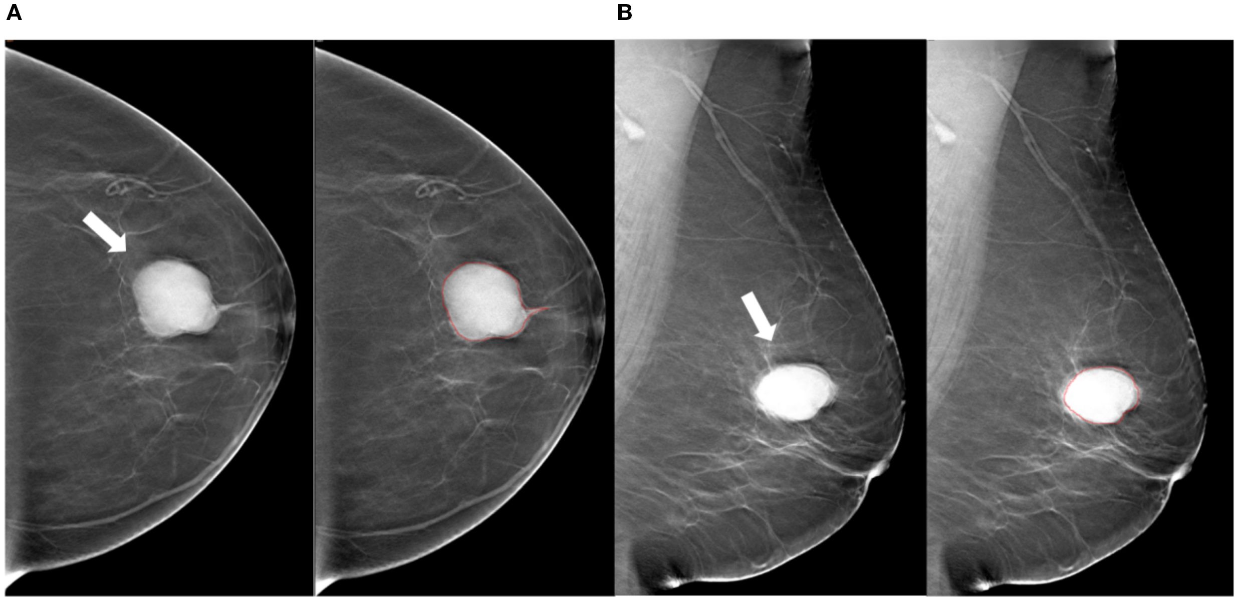 Mammogram images showing two different views labeled A and B. Each view consists of two images: one with a white arrow indicating a prominent nodule in the breast tissue, and the adjacent image with the nodule outlined in red.