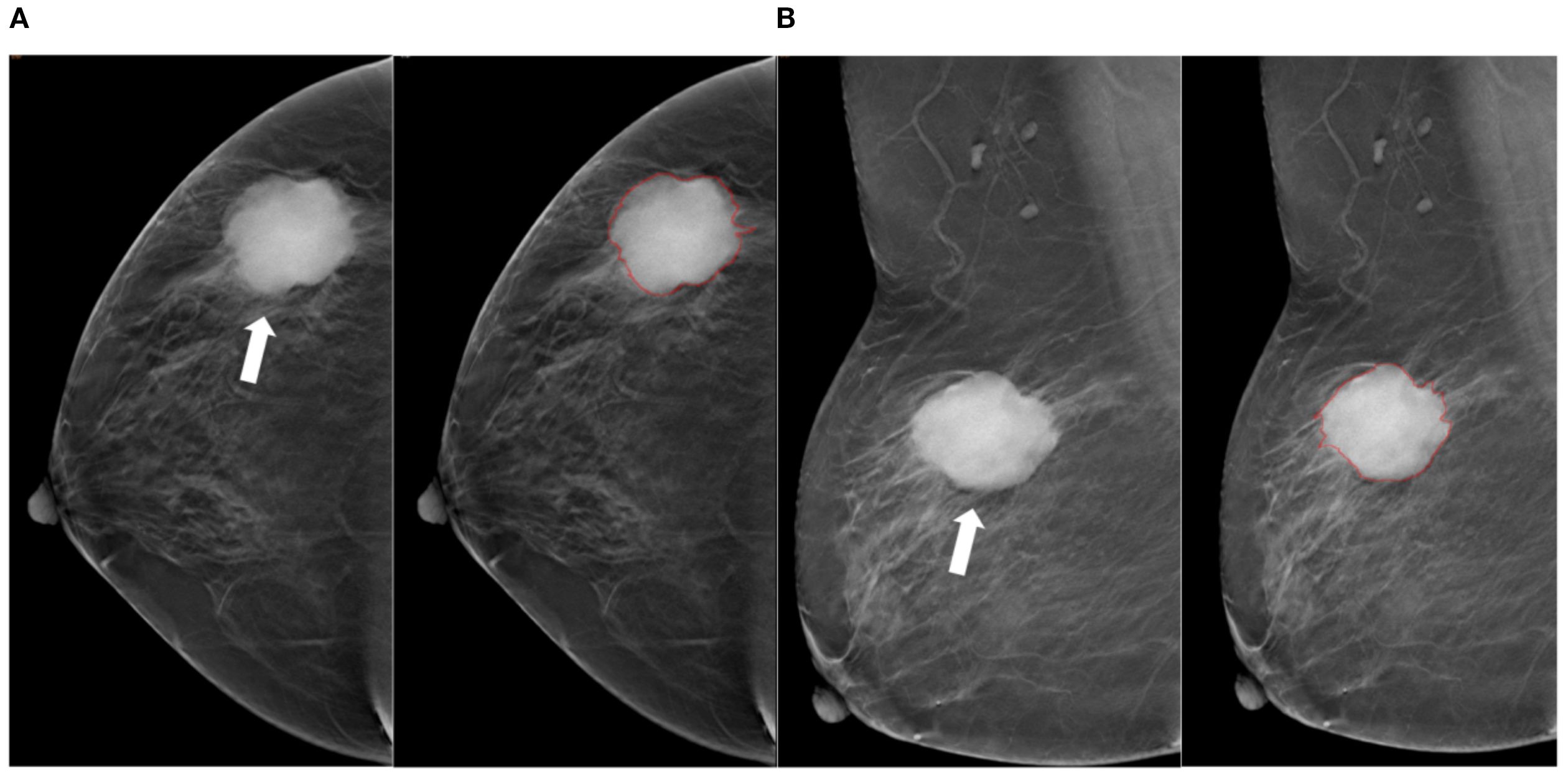 Mammogram image showing two pairs of scans labeled A and B. Each pair includes one scan with an arrow pointing to a dense, circular region, and the other scan shows the same region outlined in red. The dense regions are roughly in the center of the breast area.