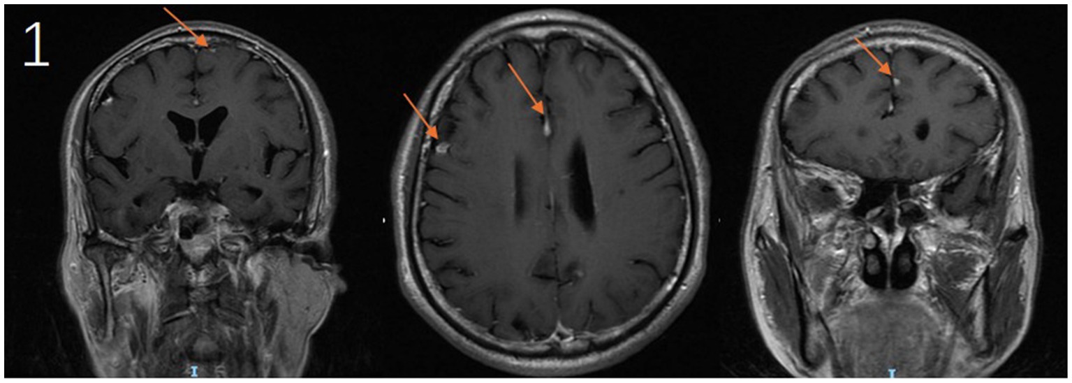 Three MRI brain scans showing different sections, each with an arrow indicating areas of interest. The left and right scans are coronal views, while the middle scan is an axial view. All arrows point to areas with abnormalities or lesions.