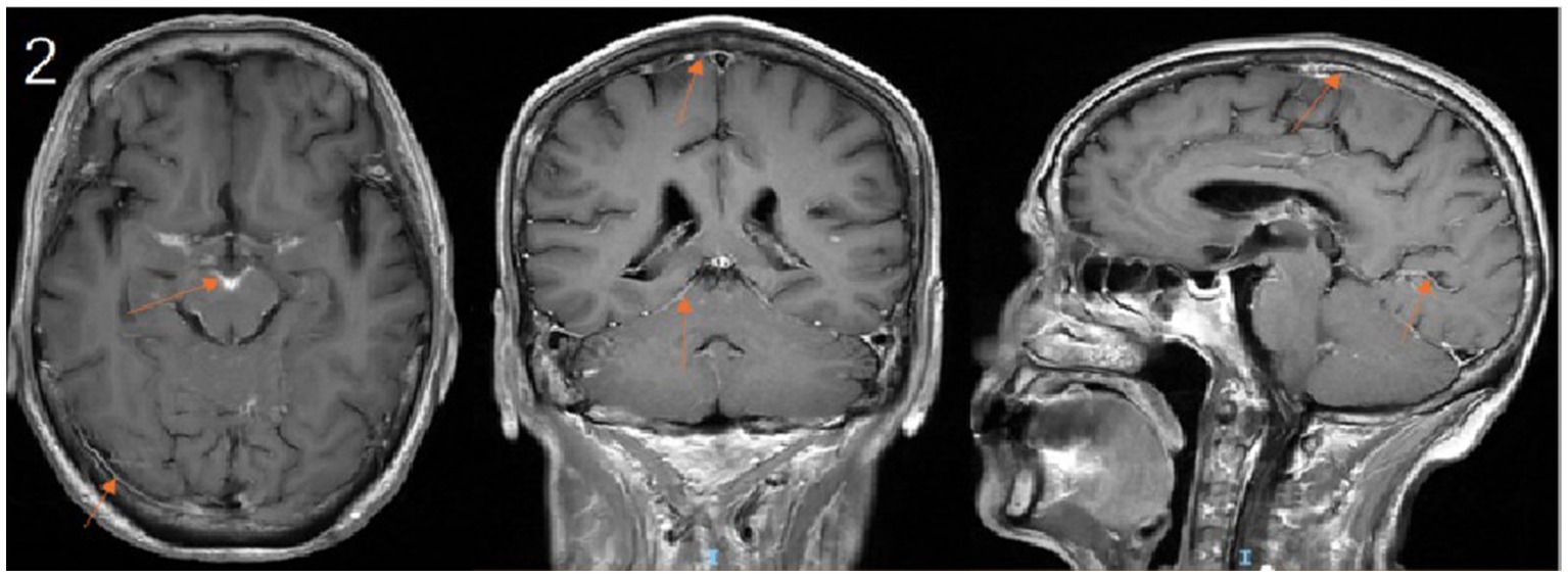 Three MRI brain scans with different views: transverse, coronal, and sagittal. Each image has orange arrows pointing to specific areas within the brain, indicating points of interest or abnormalities.