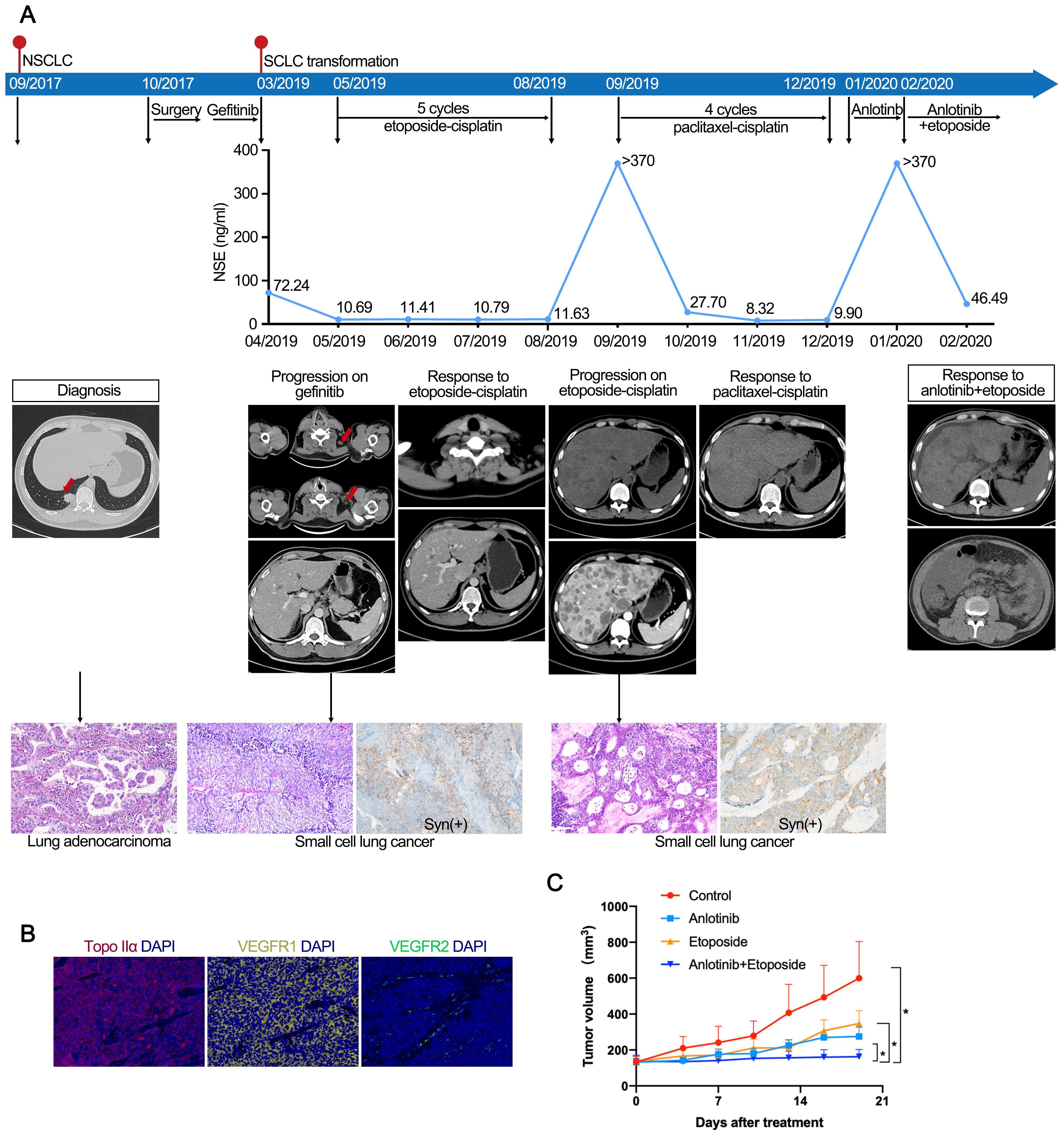 Timeline of lung cancer treatment from 2017 to 2020 shows key events and therapies: surgery, gefitinib, etoposide-cisplatin, paclitaxel-cisplatin, and anlotinib-etoposide, and highlights the transformation of lung adenocarcinoma to small cell lung cancer. A line graph shows the changes in NSE levels from 2019 to 2020.Scans depict tumor progression and response. Histology images indicate adenocarcinoma and small cell lung cancer. Panel B includes immunofluorescence staining highlights Topo IIa, VEGFR1, and VEGFR2. Panel C includes a line graph illustrating tumor volume changes over 21 days under different treatments, with lines representing control, anlotinib, etoposide, and their combination.