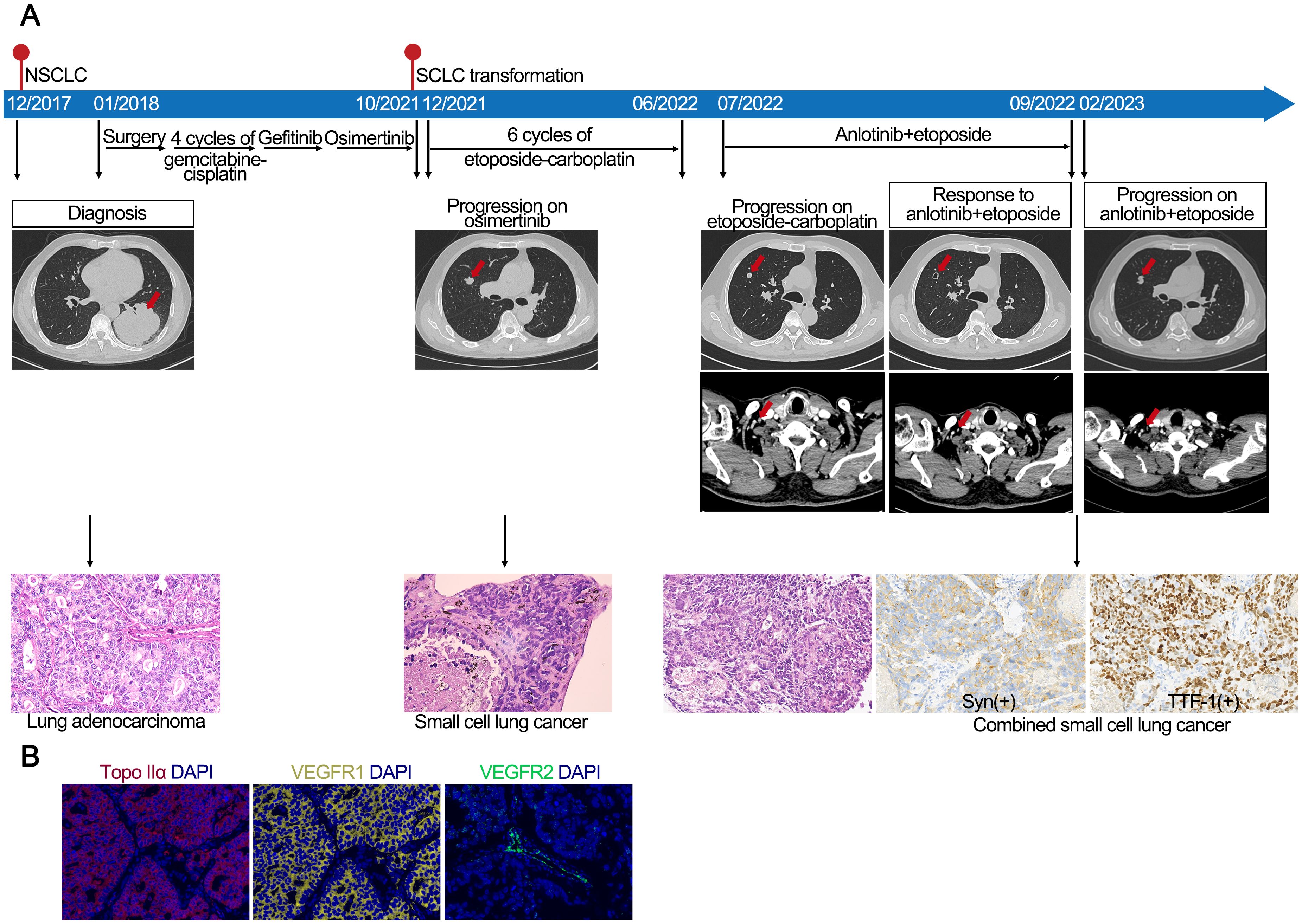 A timeline diagram depicting the progression and treatment of lung cancer from 2017 to 2023, and highlights the transformation of lung adenocarcinoma to small cell lung cancer. It shows different CT scans and histopathological images at various stages. Treatments include surgery, gemcitabine-cisplatin, gefitinib, osimertinib, etoposide-carboplatin, and anlotinib-etoposide. Key stages are labeled as diagnosis, progression on osimertinib, progression on etoposide-carboplatin, response to anlotinib-etoposide, and progression on anlotinib-etoposide. Arrow indicators point to histological images of lung adenocarcinoma, small cell lung cancer, and combined small cell lung cancer with specific markers highlighted. Panel B includes fluorescent images showing Topo IIa, VEGFR1, and VEGFR2 with DAPI staining.