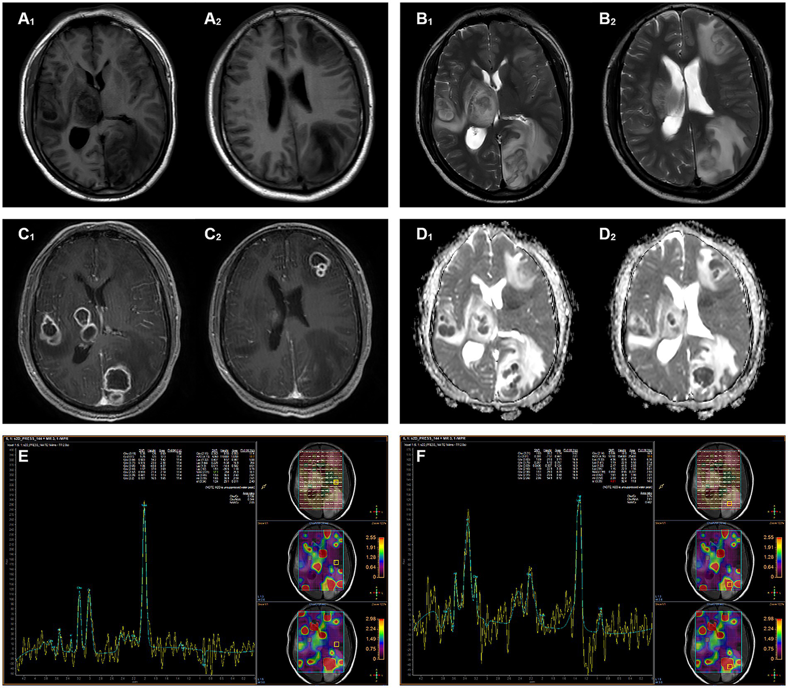 MRI scans in two rows show different brain imaging techniques. A1 and A2 are T1-weighted images; B1 and B2 are T2-weighted images; C1 and C2 are contrast-enhanced magnetic resonance (MR) images; D1 and D2 are diffusion-weighted images. Below, spectra labeled E and F display MR spectroscopy results with corresponding color maps. Each image highlights distinct brain tissue features.