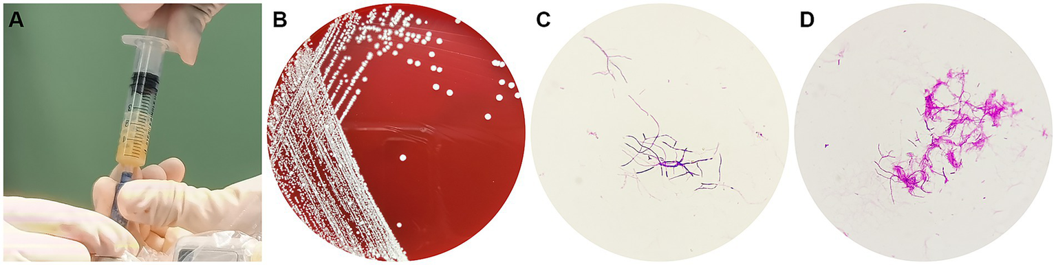 A series of four panels. A: A pale yellow pus was aspirated during the operation. B: White bacterial colonies grown on a blood agar plate. C: Gram stain reveals blue-violet, branching, filamentous bacteria by light microscopy. D: Photomicrograph of red, branching bacilli on modified acid-fast staining.