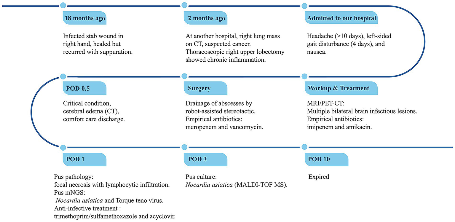 Timeline detailing a patient’s medical journey. It begins 18 months ago with an infected stab wound, then two months ago with a lung mass misdiagnosed as cancer, and admission for severe headache and nausea. Surgery involved robotic drainage of abscesses, followed by antibiotic treatment. Further MRI and PET-CT showed brain infections. By POD zero point five, the condition worsened with cerebral edema, leading to comfort care discharge. By POD one, testing of the pus by mNGS revealed Nocardia asiatica. By POD three, pus culture confirmed Nocardia asiatica. By POD ten, the patient expired.