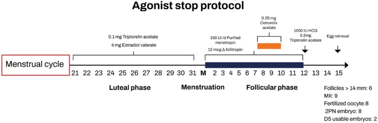 Agonist stop protocol timeline illustrating a menstrual cycle segmented into luteal, menstruation, and follicular phases. Medications include Triptorelin acetate, Estradiol valerate and Cetorelix acetate. Egg retrieval is a key event.Follicles greater than fourteen millimeters are six; nine oocytes are at stage MII; eight fertilized oocytes, with two usable embryos on day five.