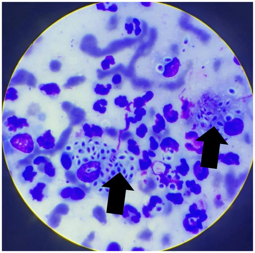 Cytology of conjunctiva (fine-needle aspiration, Romanowsky stain). Shows pyogranulomatous inflammation with neutrophils and macrophages. Yeast-like “cigar-shaped” structures with halo and basophilic center, compatible with Sporothrix spp. (arrows). No preserved tissue. Magnification: 1000×.