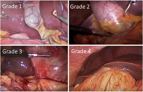 Four endoscopic images showing different grades of a medical condition in the abdominal cavity. Grade 1 shows minimal tissue change, Grade 2 shows moderate changes with slight discoloration, Grade 3 displays more pronounced discoloration and tissue alteration, and Grade 4 exhibits significant changes, including dark discoloration and uneven texture.