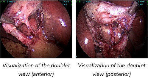 Laparoscopic images show the doublet view of a surgical area. The first image depicts the anterior view, revealing tissue and blood vessels. The second image presents the posterior view, highlighting intricate structures and surgical manipulation with instruments.