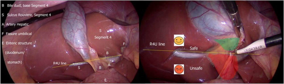 Medical illustration showing two laparoscopic views of the liver. The left side labels anatomical features: bile duct, Sulcus of Rouvier, hepatic artery, umbilical fissure, and enteric structure. The right side displays a surgical tool with areas marked as \
