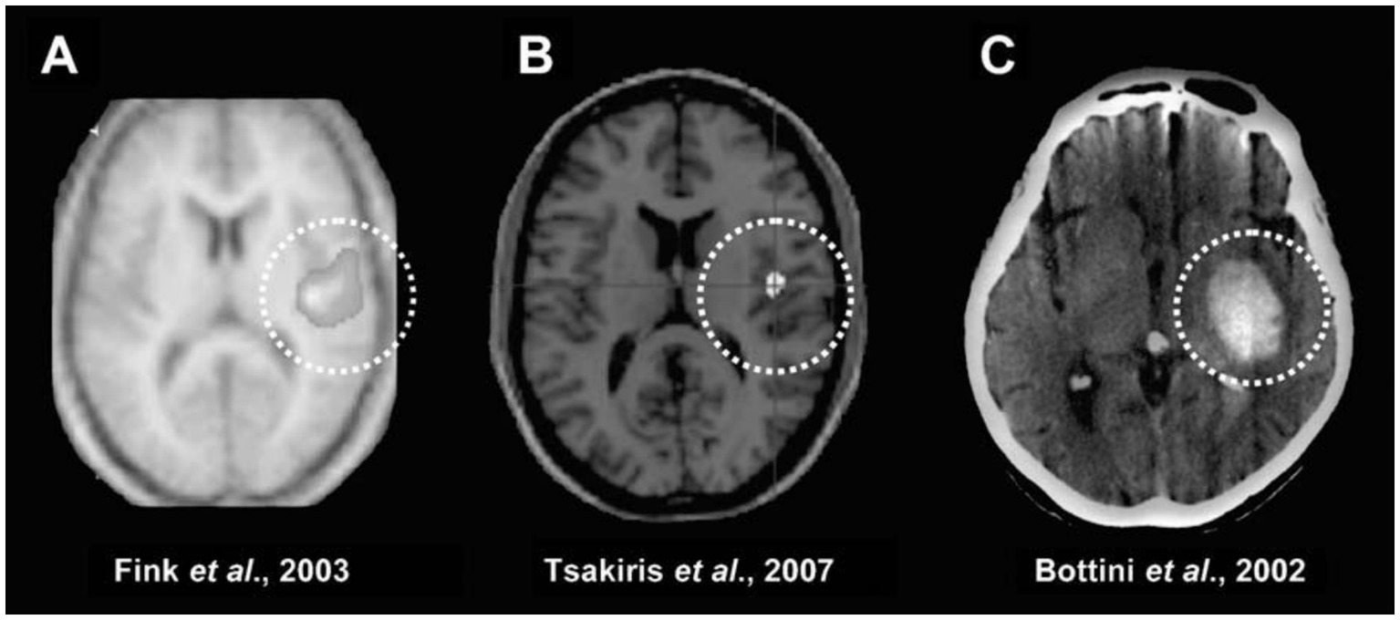 Three brain scan images in grayscale marked with circular dashed lines highlighting specific regions. Image A is labeled