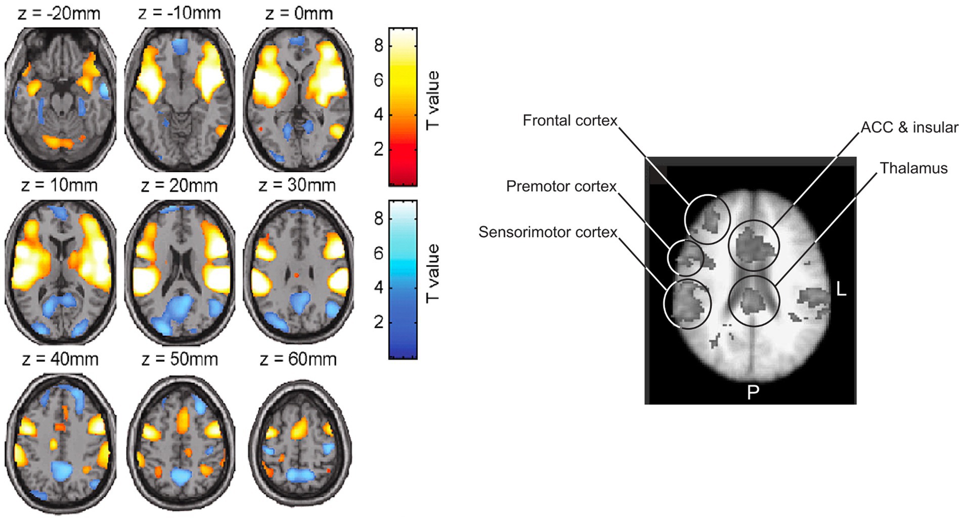 MRI brain scans at various z-coordinate levels show colored regions indicating T values. Warmer colors represent higher values, cooler colors lower. Labeled areas include the frontal cortex, premotor cortex, sensorimotor cortex, thalamus, and ACC and insular.