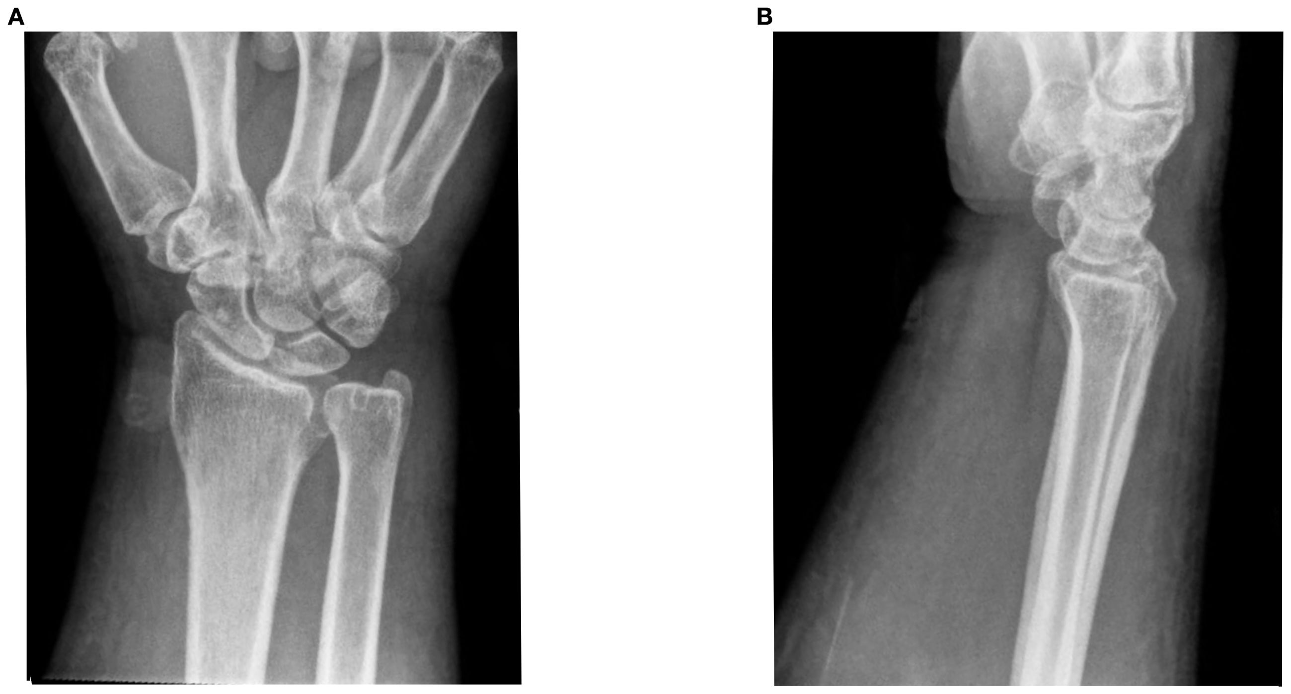 X-ray images of a wrist. Image A shows a frontal view, displaying the radius, ulna, and carpal bones. Image B presents a lateral view, highlighting the alignment of the radius and carpal bones. Both images show inflammation and soft tissue swelling of joint.