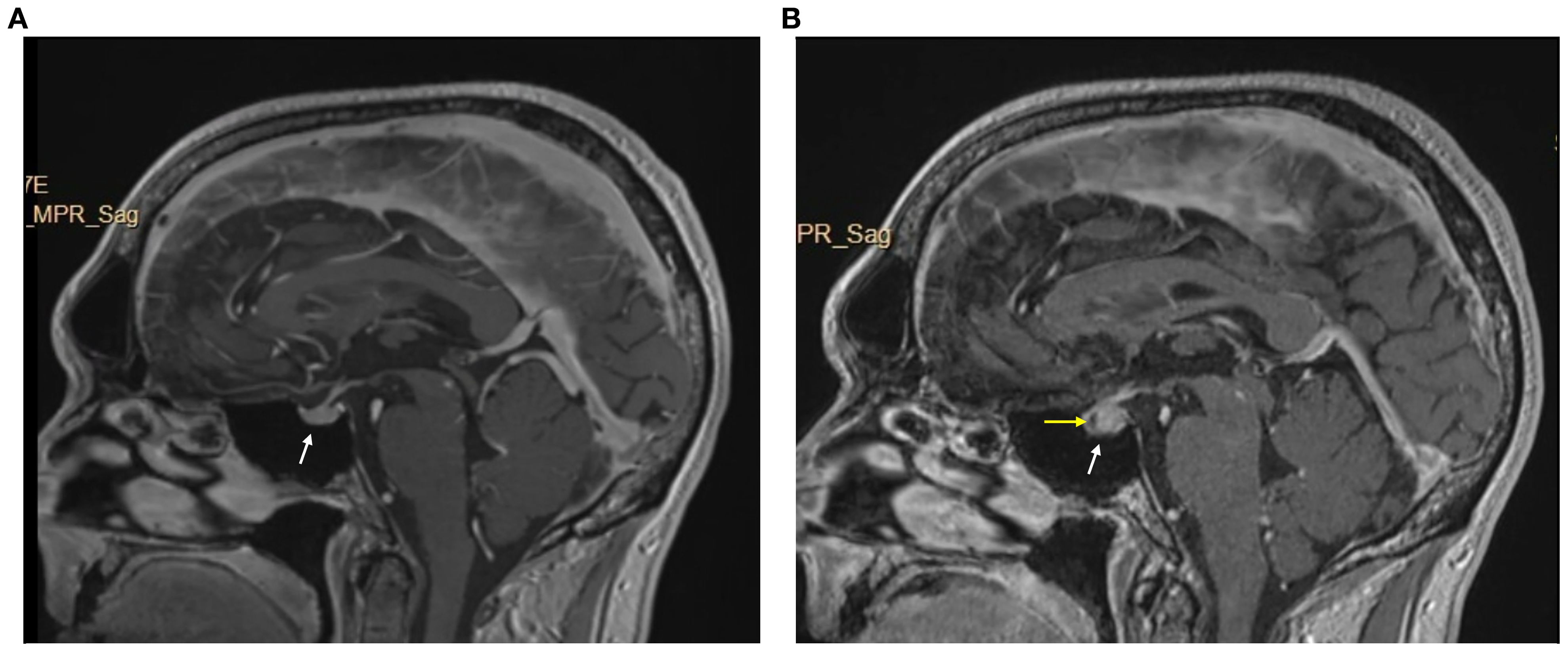 Image A highlights pituitary gland with a white arrow. Image B shows pituitary gland enlargement after starting immunotherapy (white arrow) and a new hypo-enhancing lesion (yellow arrow).