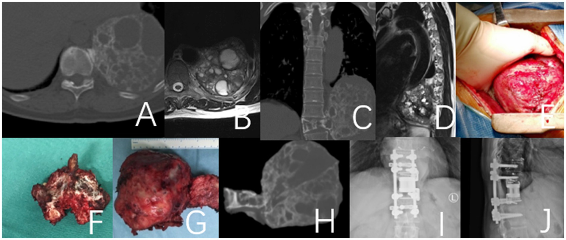 A series of medical images labeled A to J. A-D show axial, sagittal, and coronal scans of a spinal region with a large tumor. E shows surgical exposure of the tumor. F and G display the excised tumor on a surgical drape and with a ruler for scale. H shows the tumor's internal structure through imaging. I and J are postoperative X-rays depicting surgical hardware used for spinal stabilization.