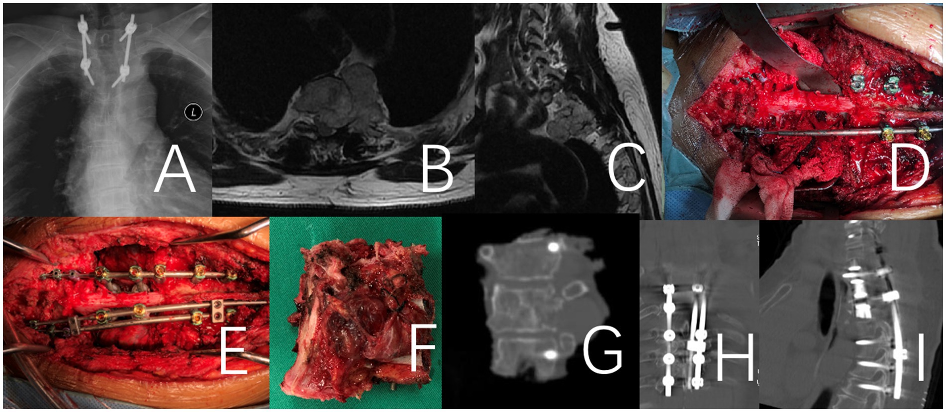 Panel of medical images labeled A to I. A: X-ray showing spinal screws. B and C: MRI scans with spine details. D: Surgical view of spine with hardware. E: Intraoperative image of spine with fixation. F: Excised tissue sample. G: CT scan with vertebral details. H and I: CT scans showing spinal fixation with screws.