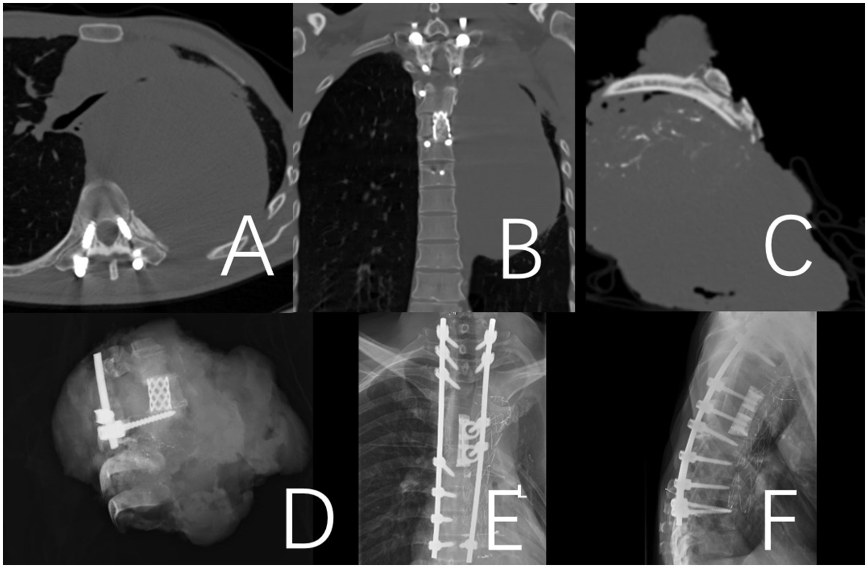 CT and X-ray images labeled A to F show different views of spinal hardware placements. A depicts a transverse CT slice with spinal screws. B shows a frontal CT view of the spine. C presents a lateral CT image of the cervical region. D provides an oblique X-ray of spinal hardware. E features an anterior X-ray of the spine with rods and screws. F displays a lateral X-ray highlighting the screws along the thoracic spine.