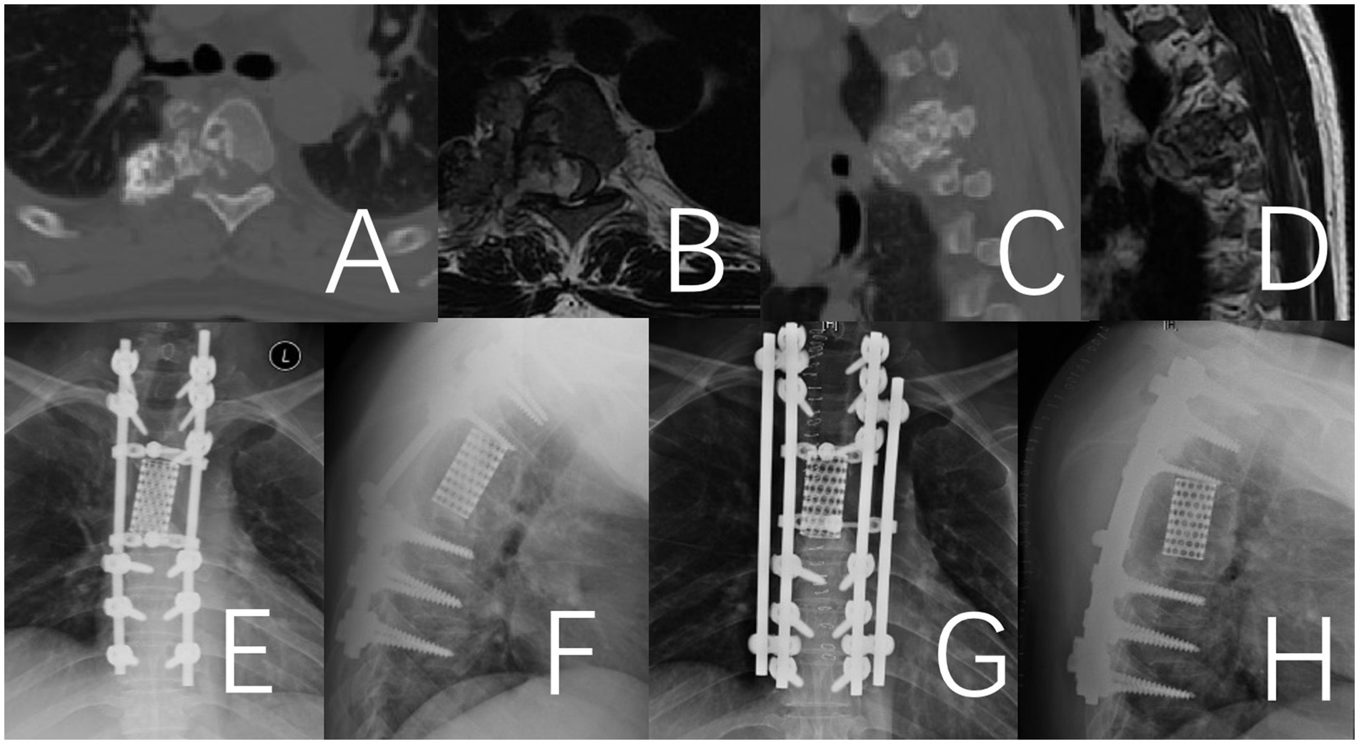 Panels A to D show medical imaging of the thoracic spine using CT and MRI scans, revealing significant vertebral body destruction between T-three and T-seven due to a mass. Panels E to H display postoperative X-rays from anterior-posterior and lateral views, revealing the placement of an expandable cage and posterior spinal instrumented fusion from T-two to T-eight.
