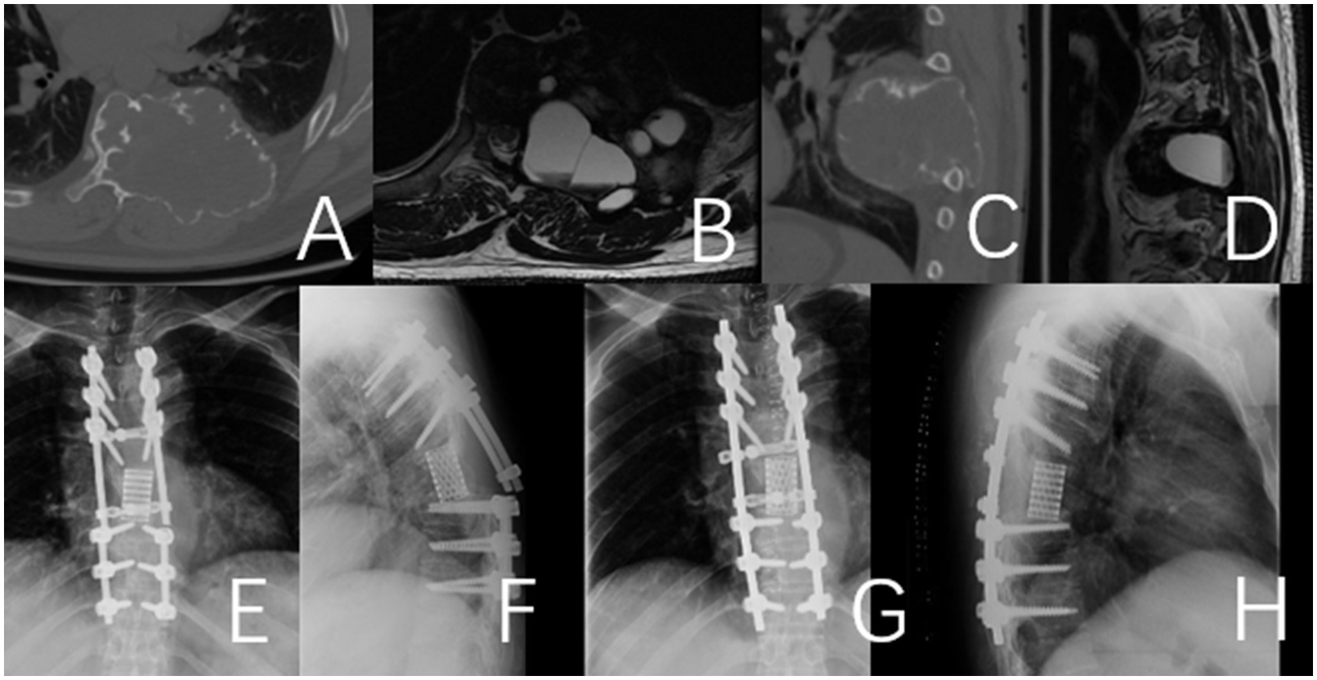 Medical imaging collage with eight panels labeled A to H. Panels A to D show diagnostic scans of the chest and spine using CT and MRI. Panels E to H display X-rays of the spine post-surgery with visible metal implants and screws.