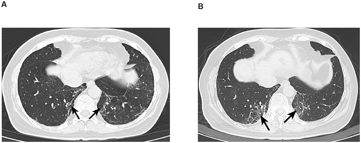 CT scans of lungs in two panels labeled A and B. Both images show transverse sections of the lungs, highlighting pulmonary fibrosiss. Arrows point to areas of dense tissue, indicating possible interstitial lung disease. The surrounding lung tissue appears mostly clear.